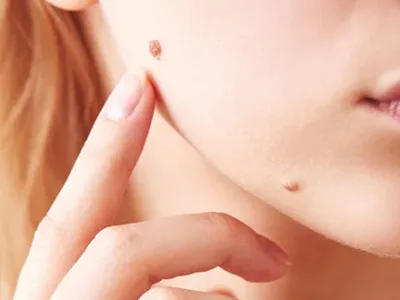 lazer-ile-ben-alımı